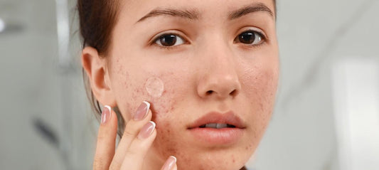 Mengapa Acne Patch Jadi Andalan untuk Jerawat? Temukan Faktanya!