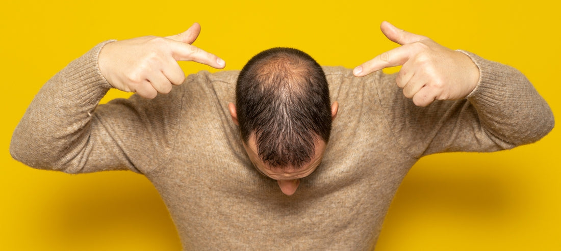 Rambut Semakin Menipis? Ini Rahasia Ampuh Mengatasi Rambut Rontok pada Pria!